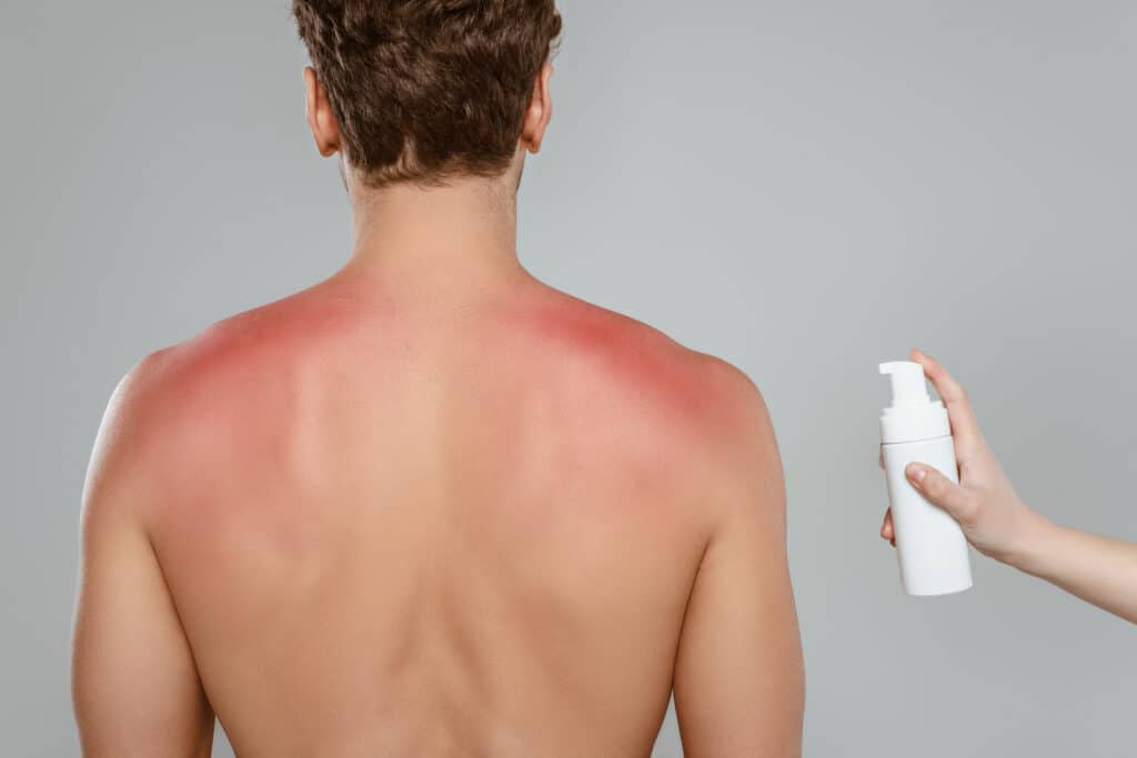Cropped view of woman holding bottle of foam near man with sunburn isolated on grey