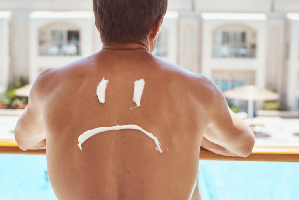 Sad smile painted on man back with sunscreen. Sunburn protection concept