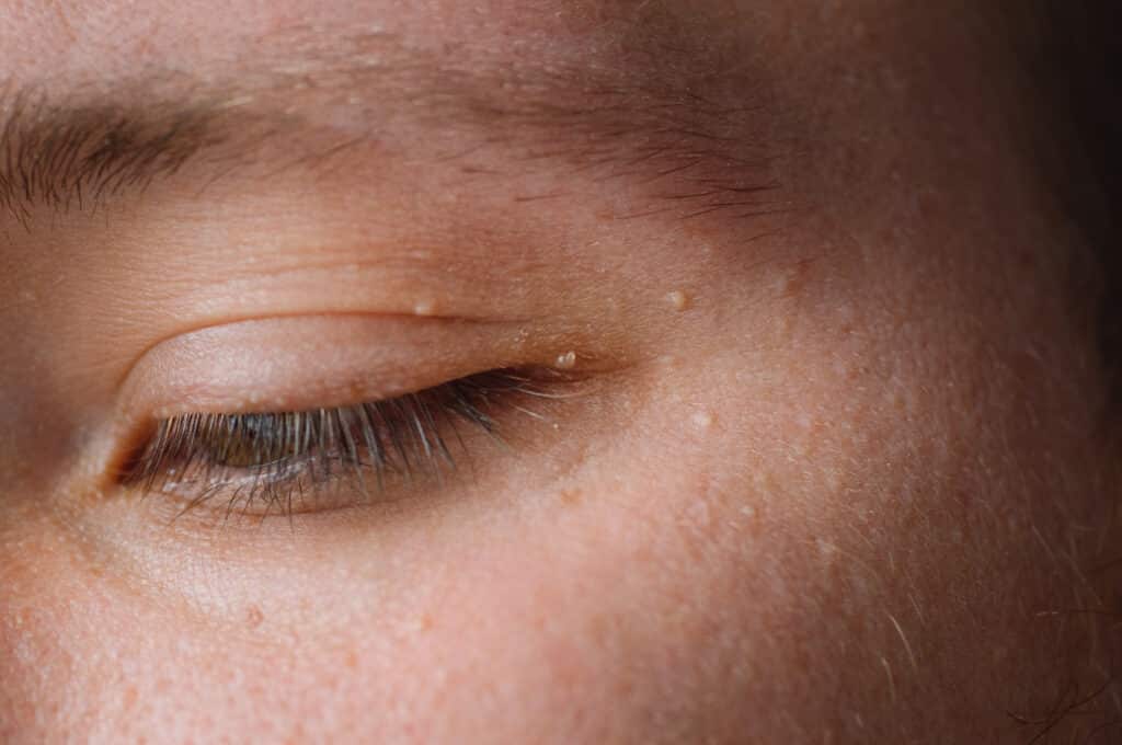 Eyes of young man with small papillomas on eyelids or growths on skin. Face closeup.