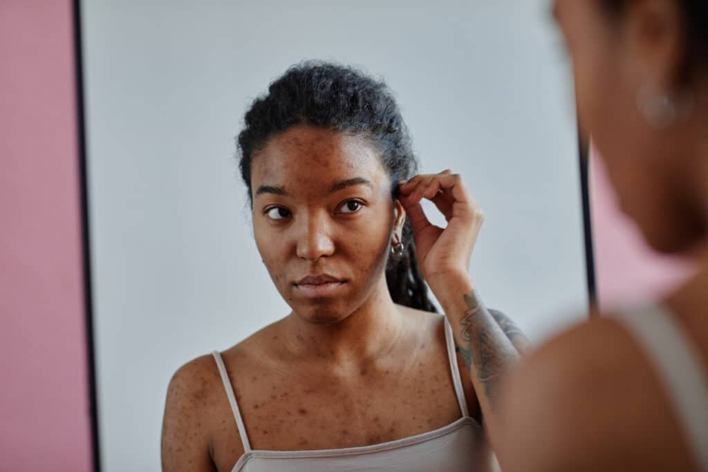 Portrait of young black woman with acne scars looking in mirror insecure in appearance.