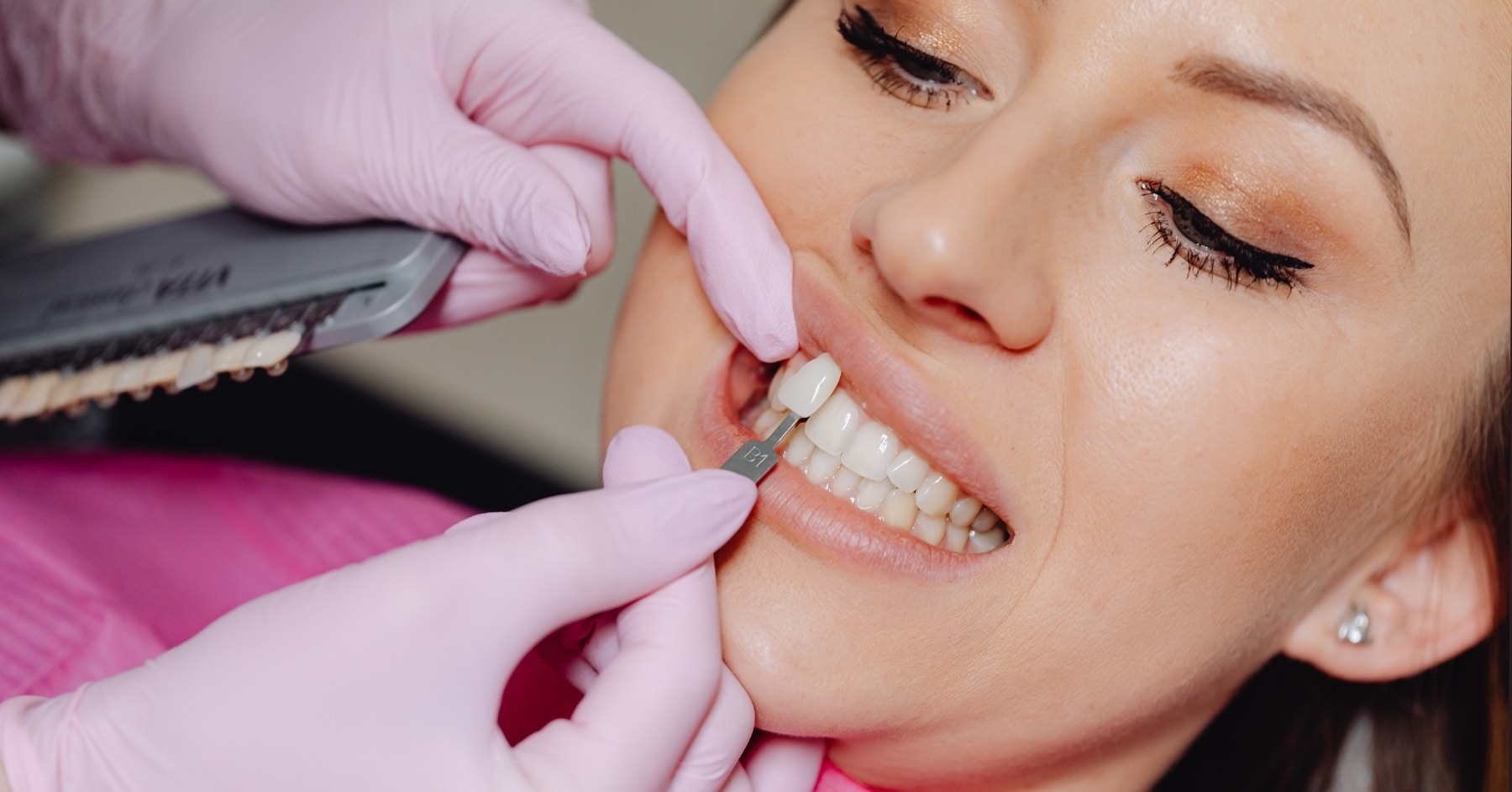 Read more about the article Let Composite Veneers Transform Your Smile and Your Life