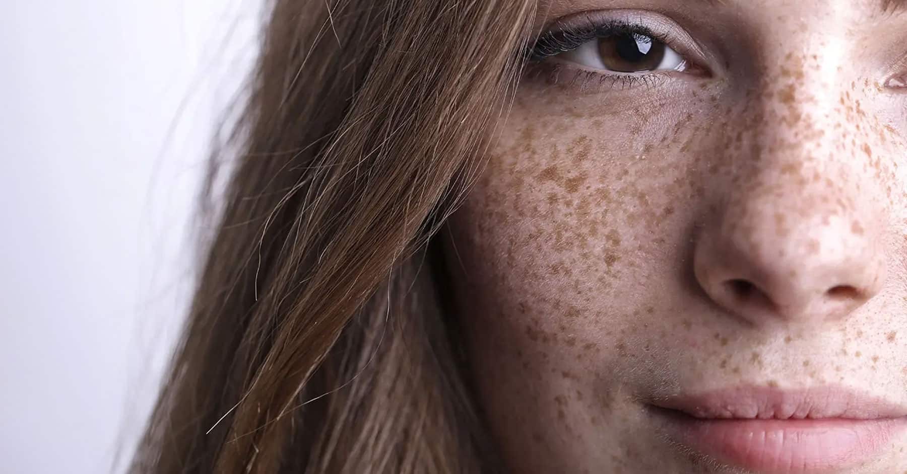 sun spots on the face